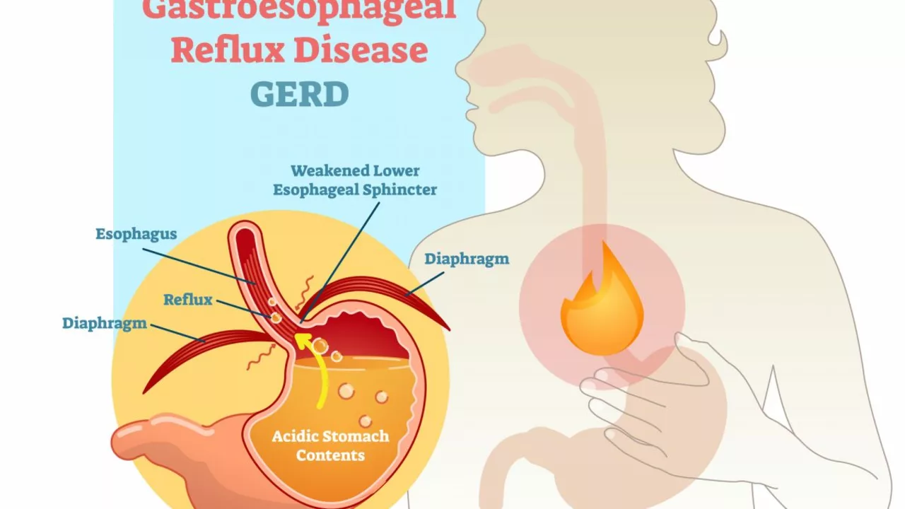 Clarithromycin and Gastroesophageal Reflux Disease (GERD): A Guide to Treatment